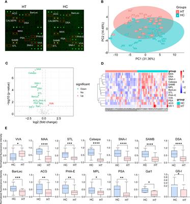 Altered profile of glycosylated proteins in serum samples obtained from patients with Hashimoto′s thyroiditis following depletion of highly abundant proteins